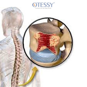 What-is-multiple-myeloma-bone-disease-min